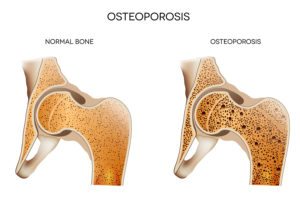 Homecare in Amberley OH: Senior Care Tips For Osteoporosis